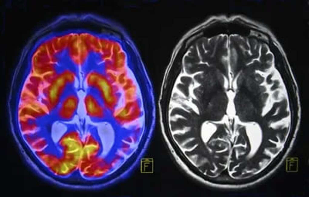 La verdad sobre la dopamina: El Neurotransmisor que controla la motivación y el placer