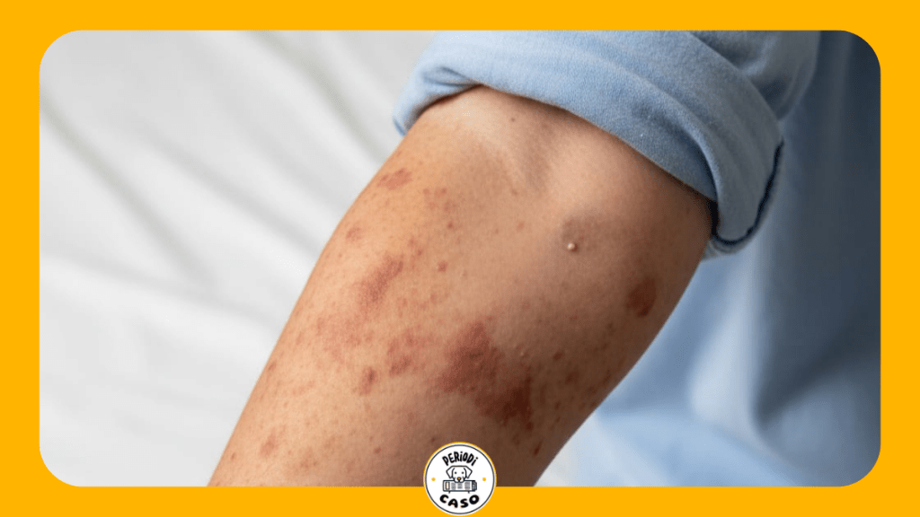 Alertan por repunte de sarampión; confirman casos en Puebla y Tlaxcala